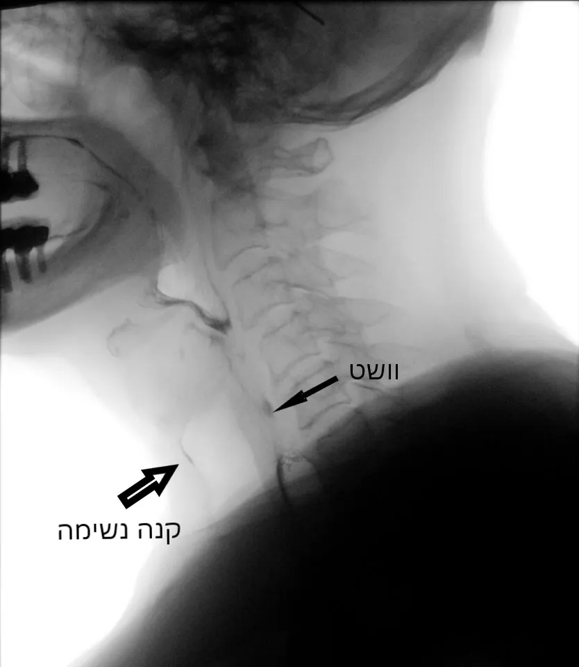 צילום מתוך Videofluoroscopy המראה את החלקים הנבדקים